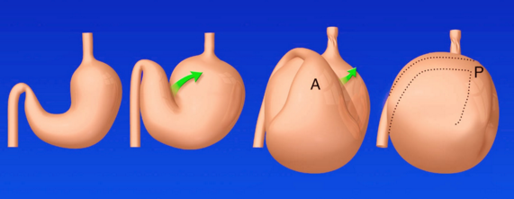 Dilatação Gástrica