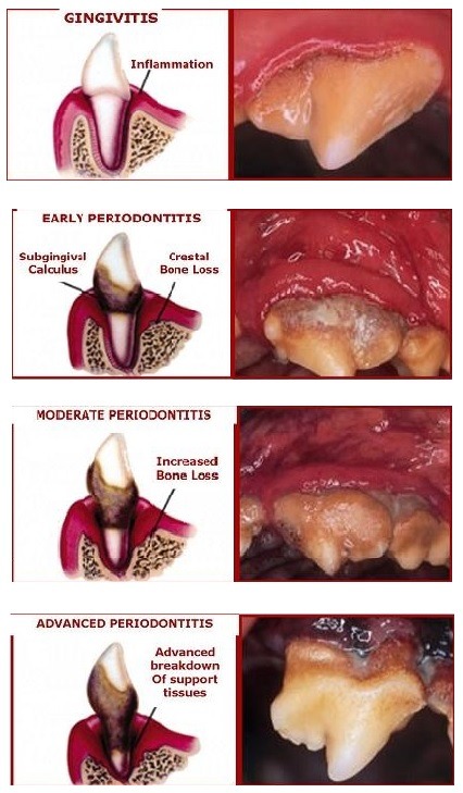 Doença Periodontal